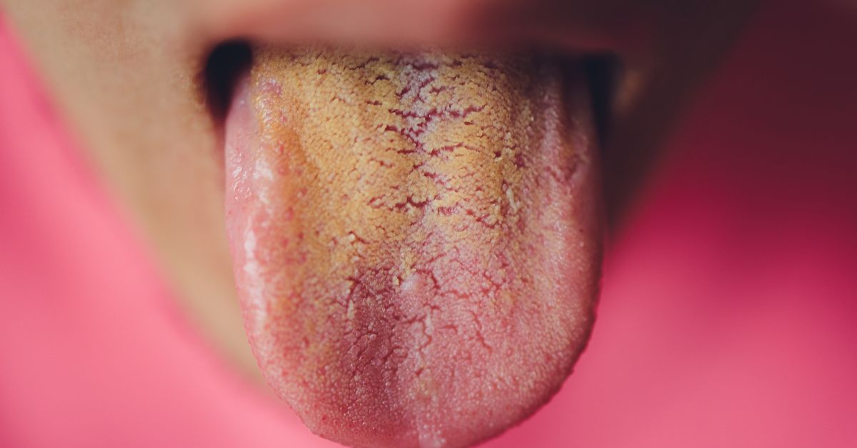 What Those Spots on Your Tongue Mean
