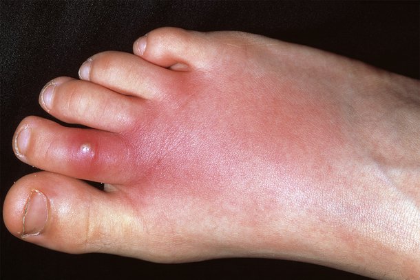 Read more about the article Foot Rash: Symptoms, Causes, and Treatments You Need to Know