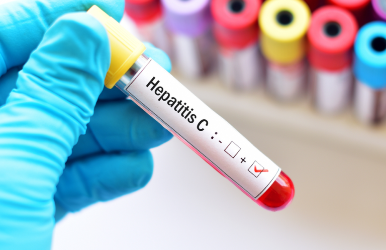 Read more about the article Hepatitis C Positive? Here’s What You Need To Know